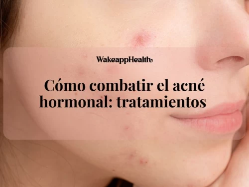 Cómo combatir el acné hormonal: tratamientos 