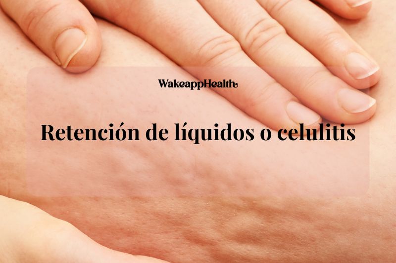 Retención de líquidos o celulitis