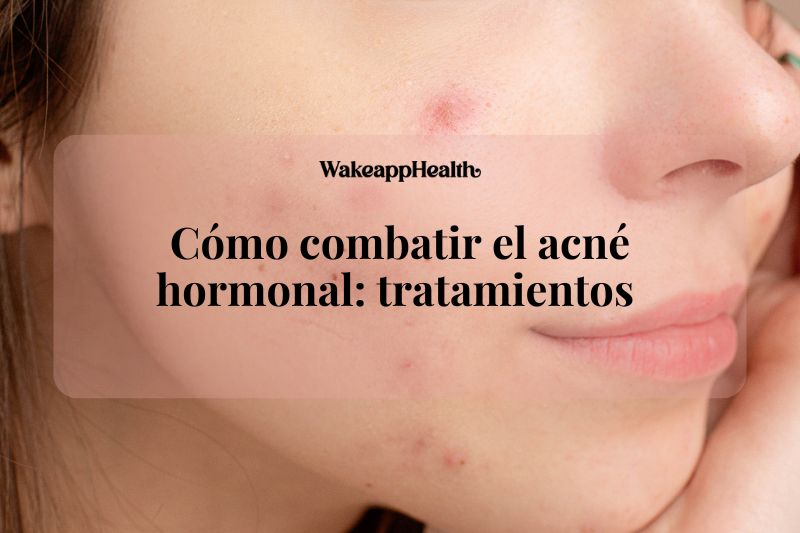 Cómo combatir el acné hormonal: tratamientos 